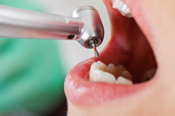 Best Emergency Root Canal Treatment in Needville, TX